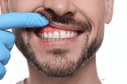 Can Castor Oil Help Abscessed Teeth?